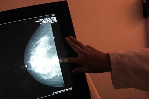 A monitor shows the image of breast cancer at a center in Mexico City October 18, 2012. Opponents of Myriad's patent claim it will harm research and preventative tests.